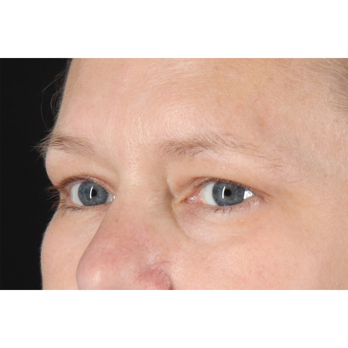 Blepharoplasty (Eyelid Surgery) Before & After Patient #10991