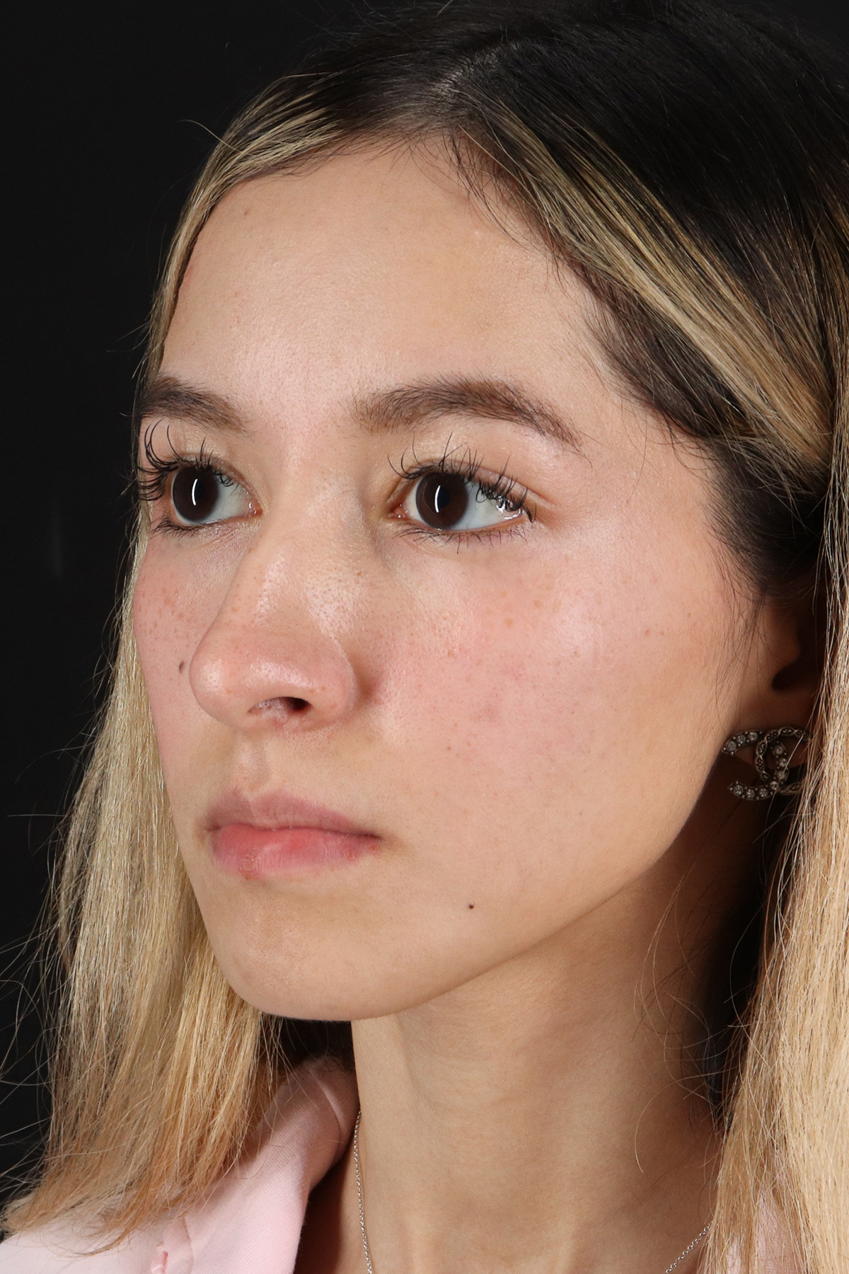 Rhinoplasty Before & After Patient #12216