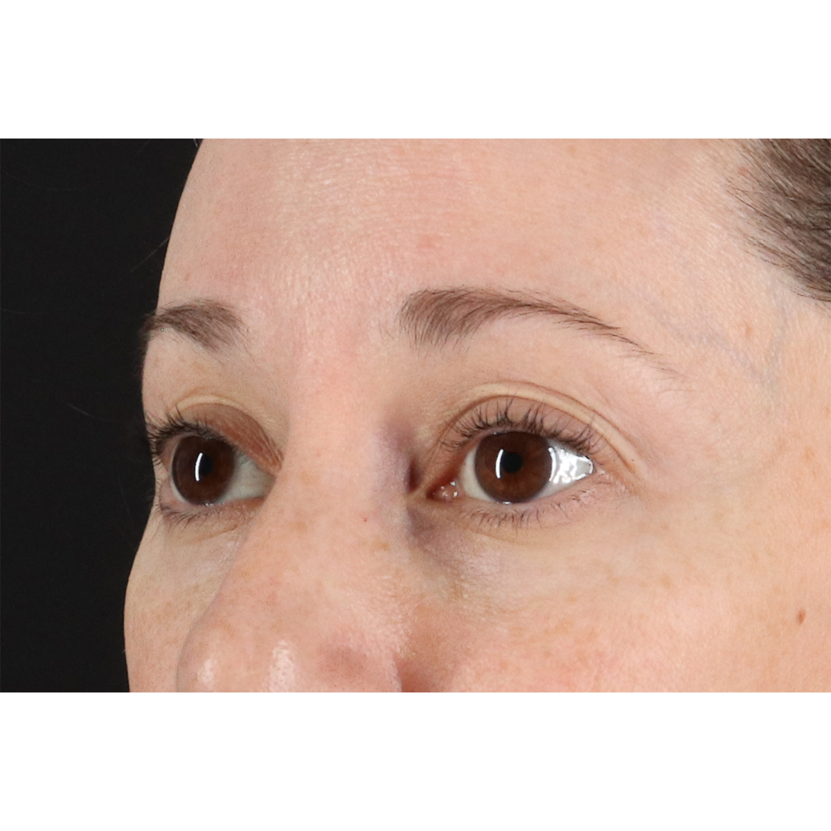 Blepharoplasty (Eyelid Surgery) Before & After Patient #11114