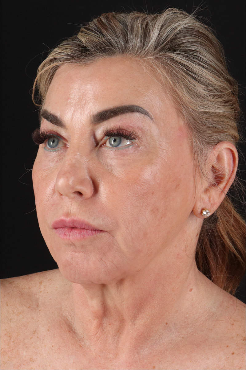 Facelift Before & After Patient #11462