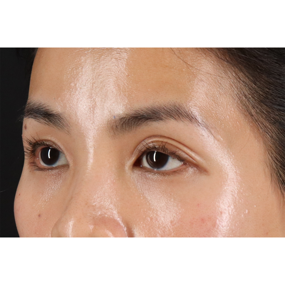 Blepharoplasty (Eyelid Surgery) Before & After Patient #10782