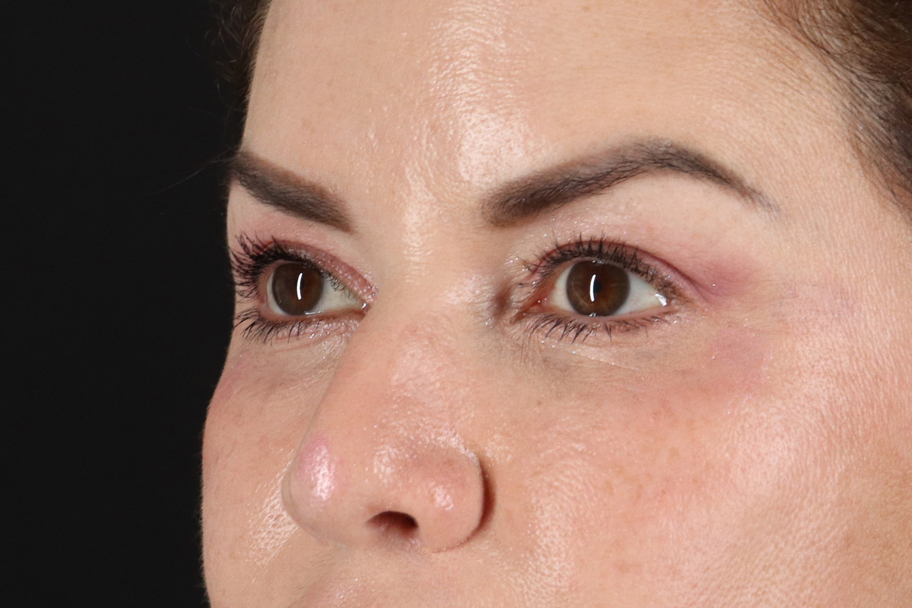 Upper Blepharoplasty Before & After Patient #12073