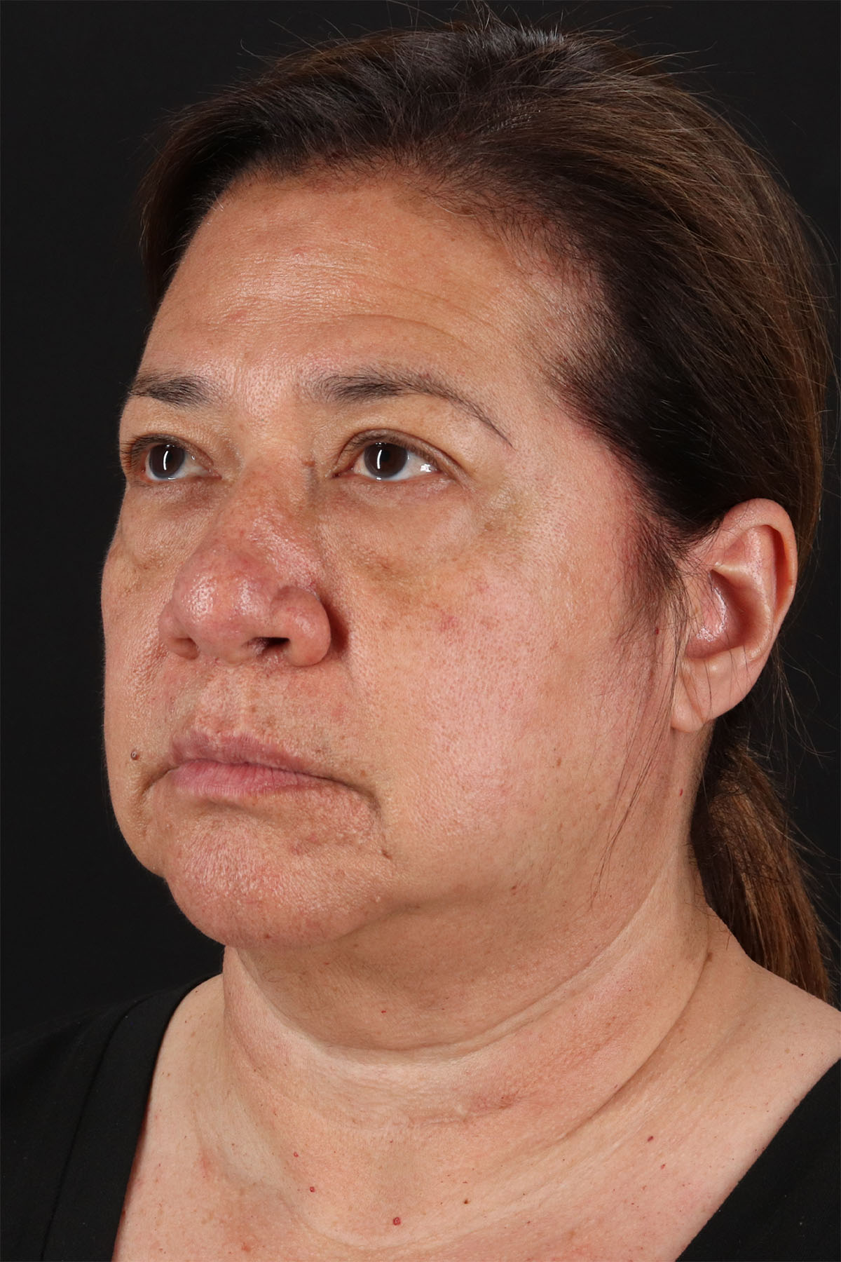 CO2 Laser Before & After Patient #11136