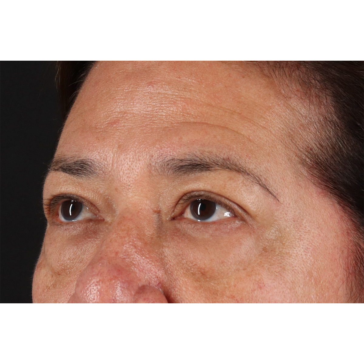 Blepharoplasty (Eyelid Surgery) Before & After Patient #11125