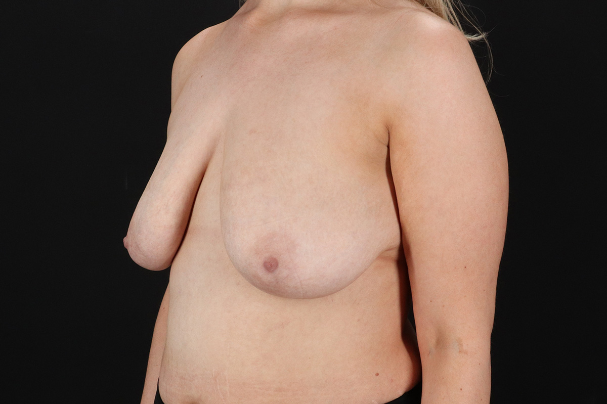 Breast Reduction With Lift Before & After Patient #11473
