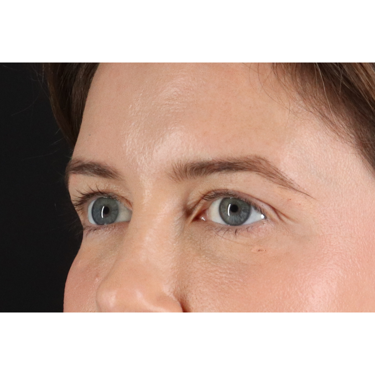 Blepharoplasty (Eyelid Surgery) Before & After Patient #11517