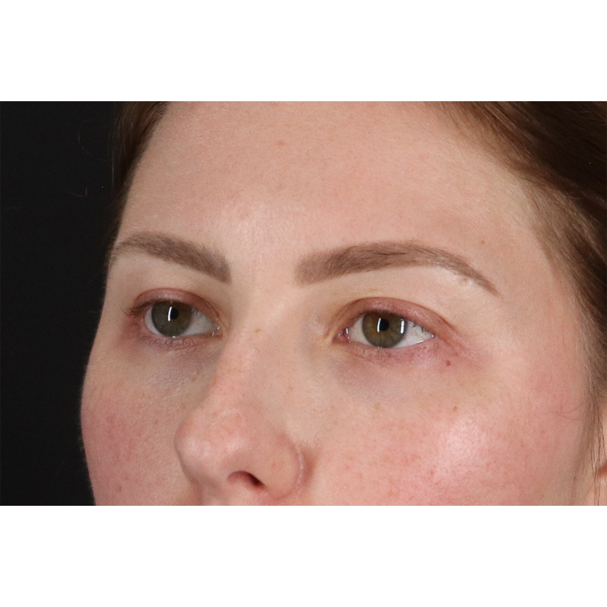 Brow Lift Before & After Patient #11657