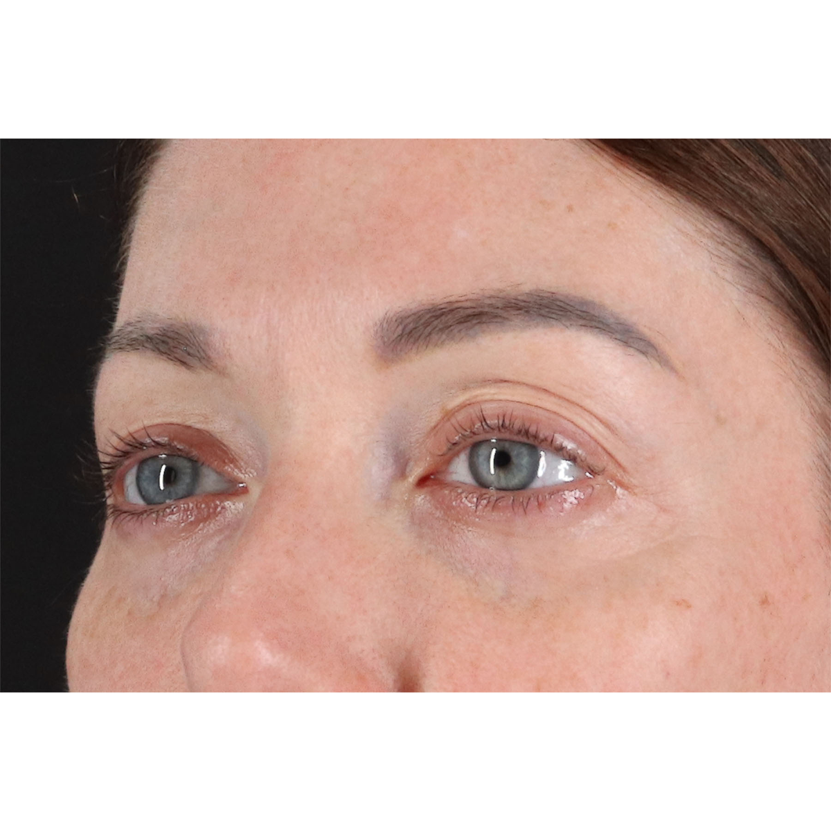 Blepharoplasty (Eyelid Surgery) Before & After Patient #11026