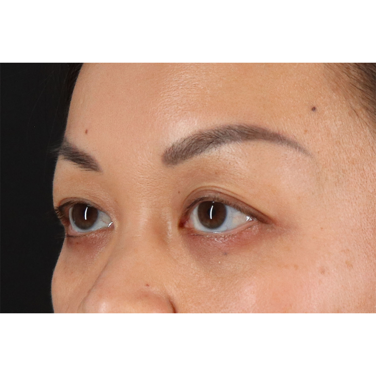 Blepharoplasty (Eyelid Surgery) Before & After Patient #11037