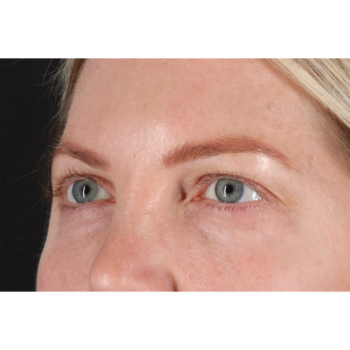 Blepharoplasty (Eyelid Surgery) Before & After Patient #11158