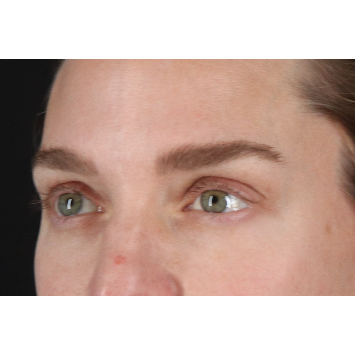 Blepharoplasty (Eyelid Surgery) Before & After Patient #11541