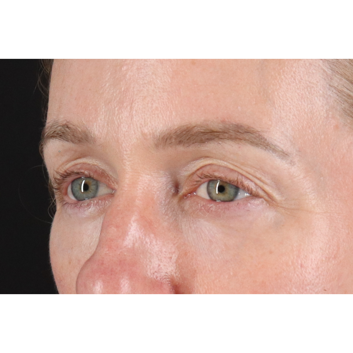 Blepharoplasty (Eyelid Surgery) Before & After Patient #11883