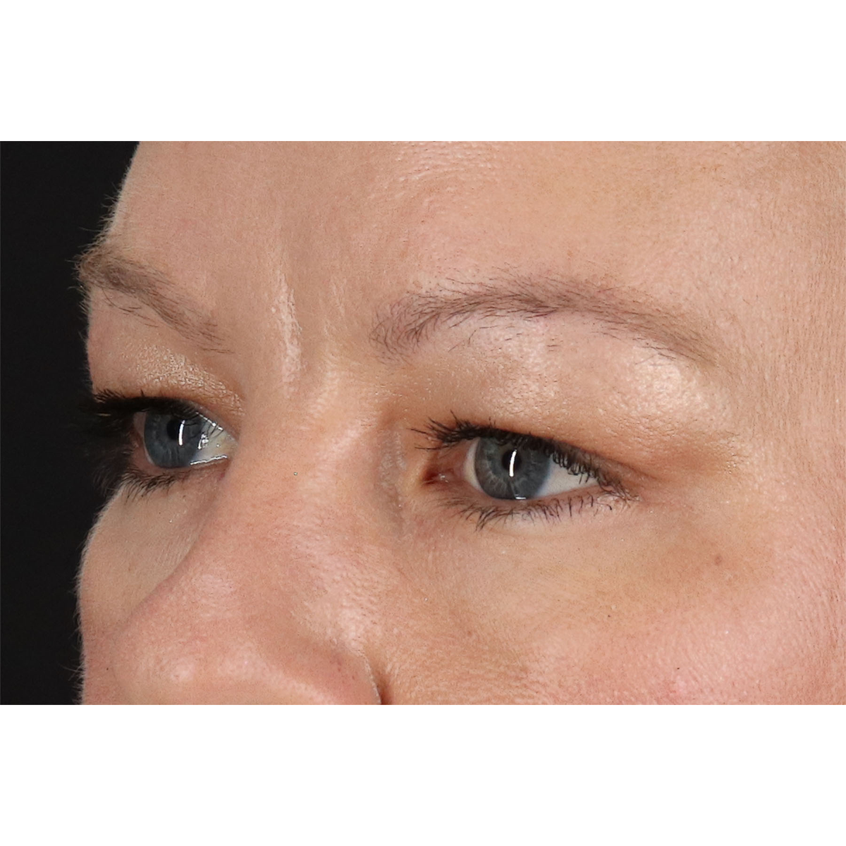 Blepharoplasty (Eyelid Surgery) Before & After Patient #11048