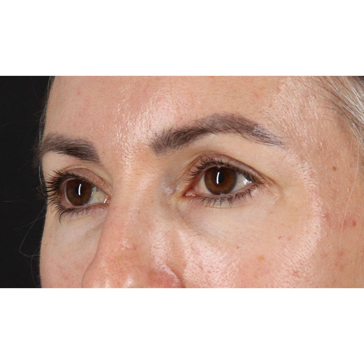 Blepharoplasty (Eyelid Surgery) Before & After Patient #11282