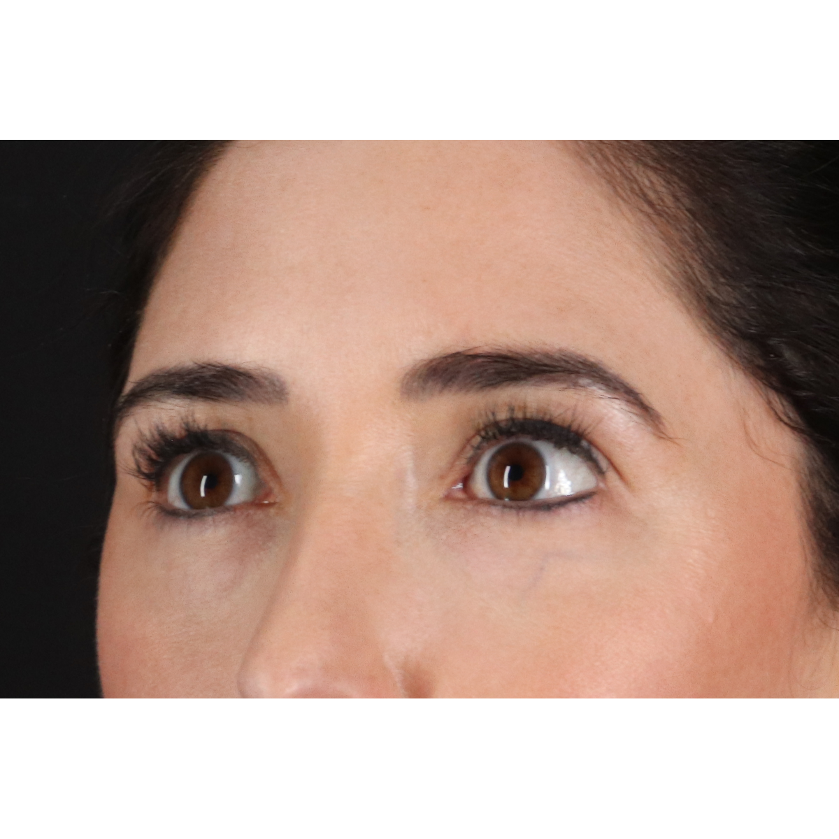Blepharoplasty (Eyelid Surgery) Before & After Patient #11668