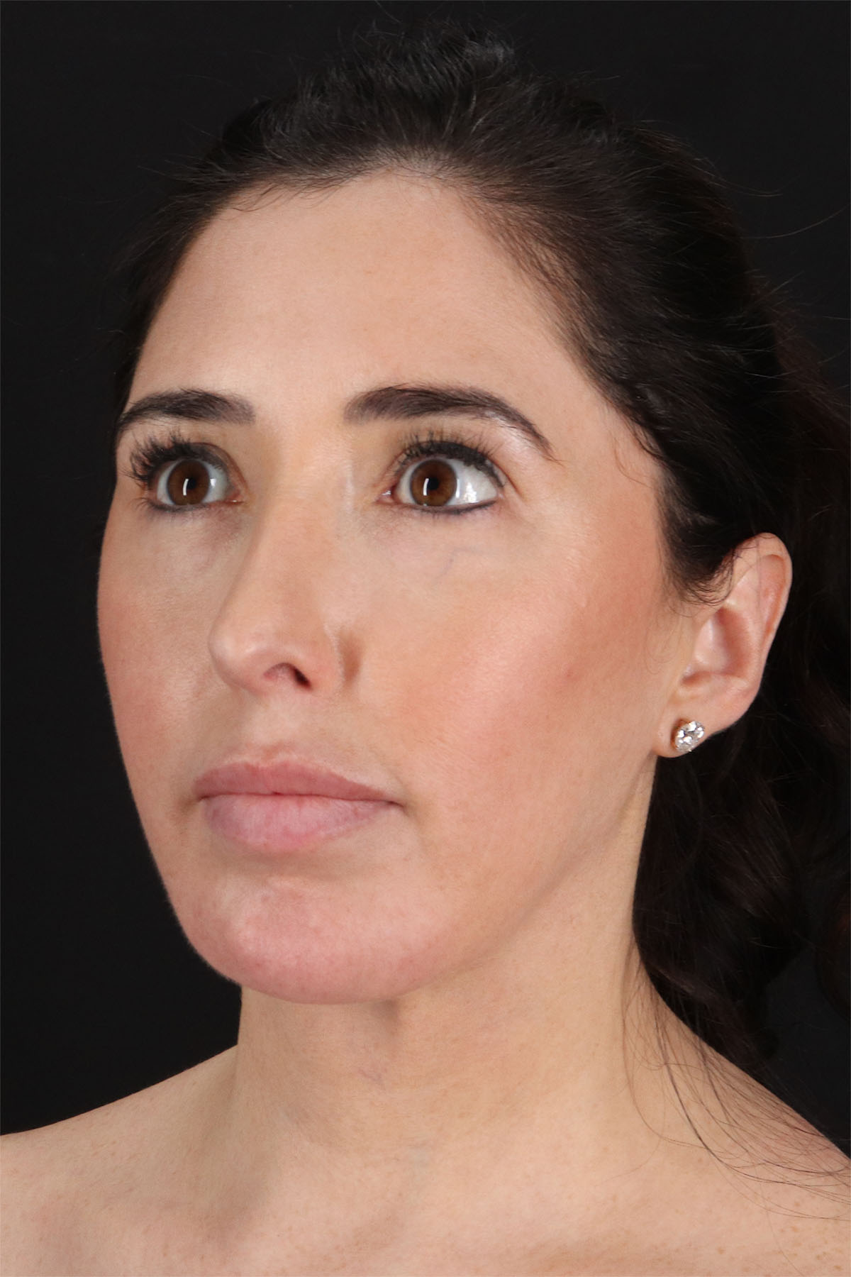 Fat Grafting To The Face Before & After Patient #11783