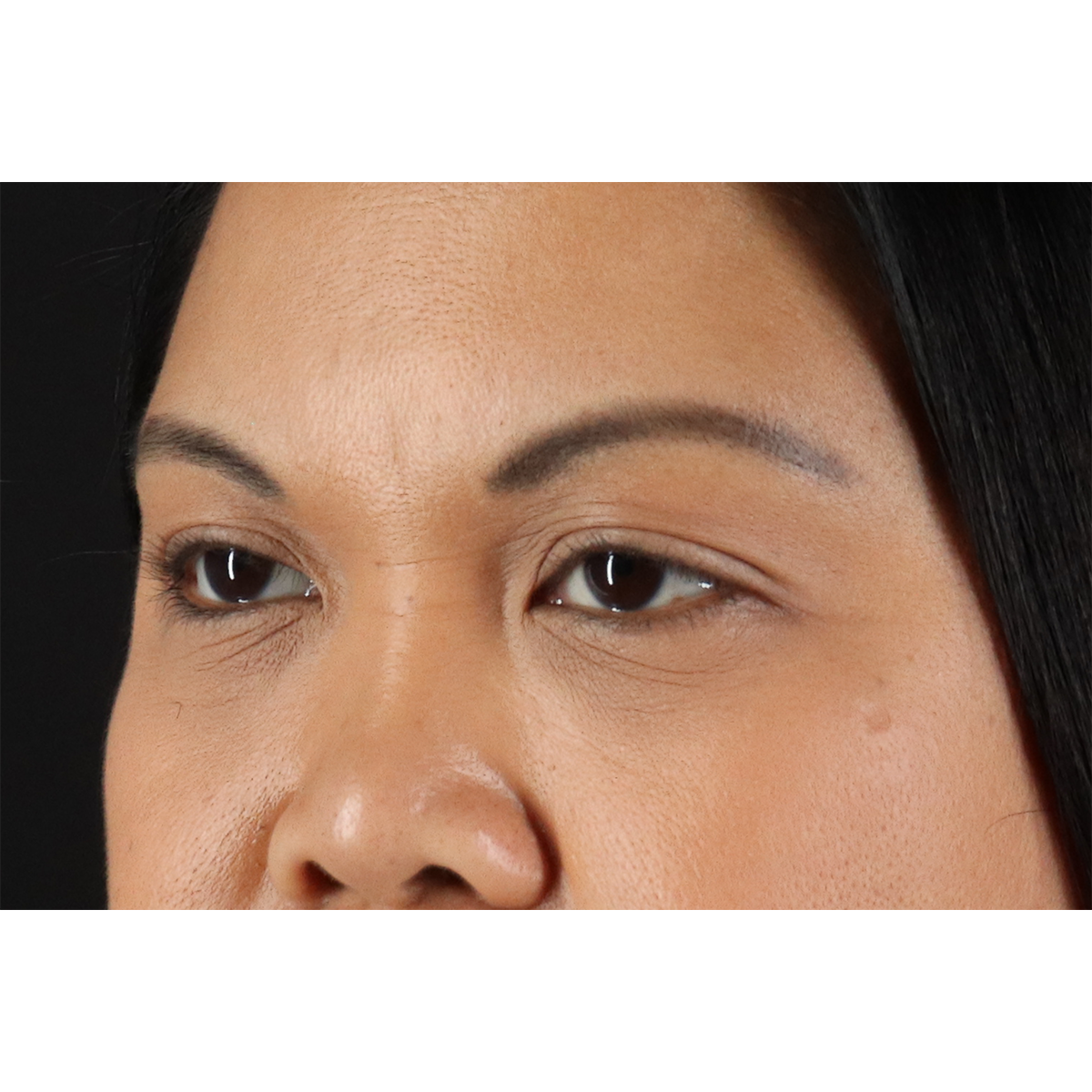 Brow Lift Before & After Patient #11646