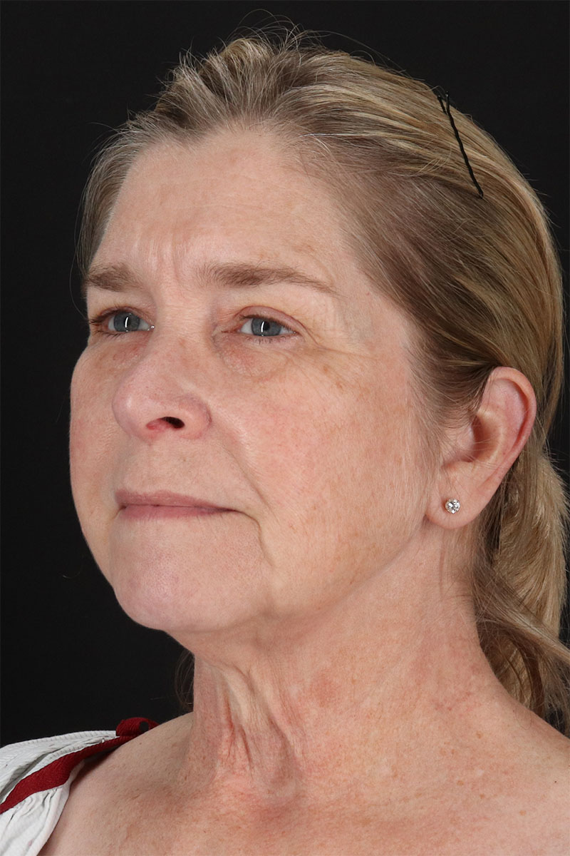 CO2 Laser Before & After Patient #11191