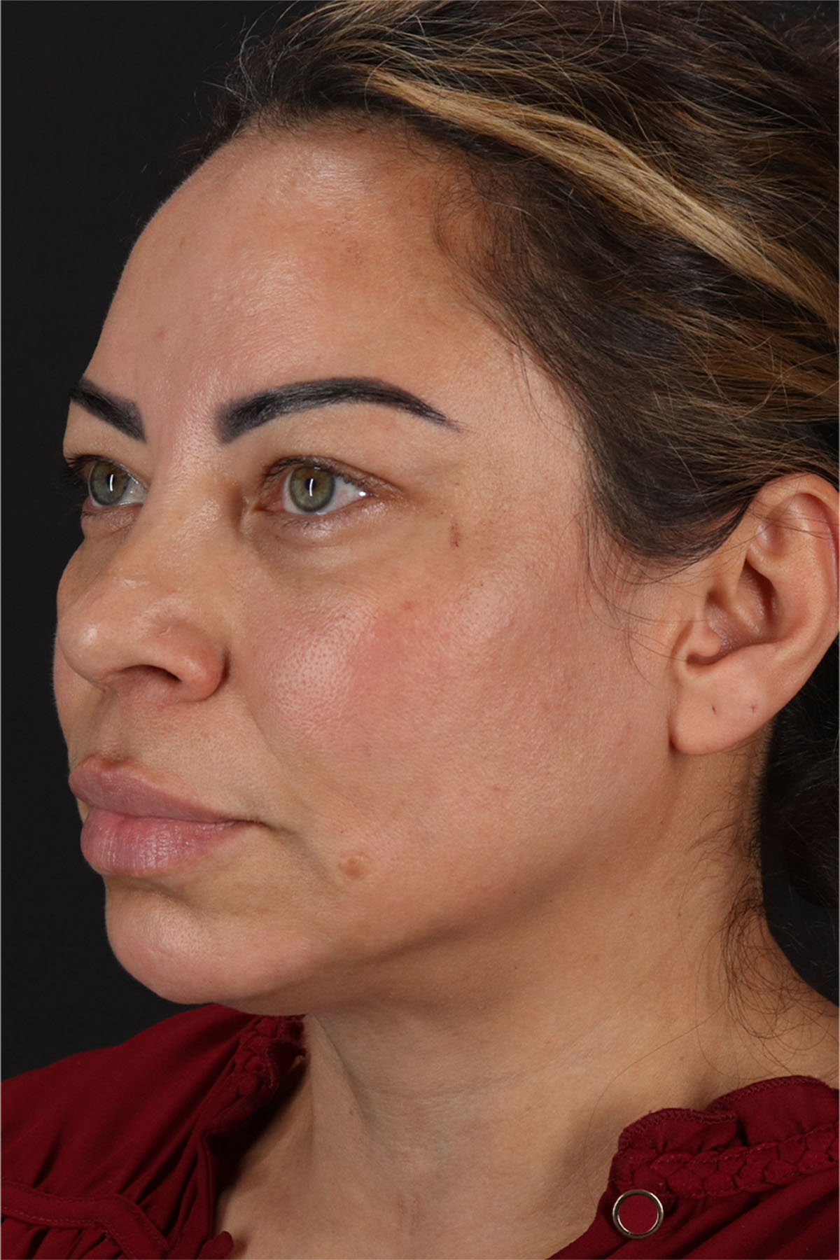 CO2 Laser Before & After Patient #11719