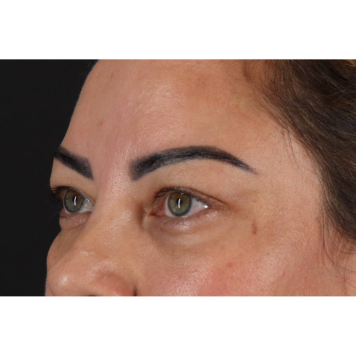 Blepharoplasty (Eyelid Surgery) Before & After Patient #11348