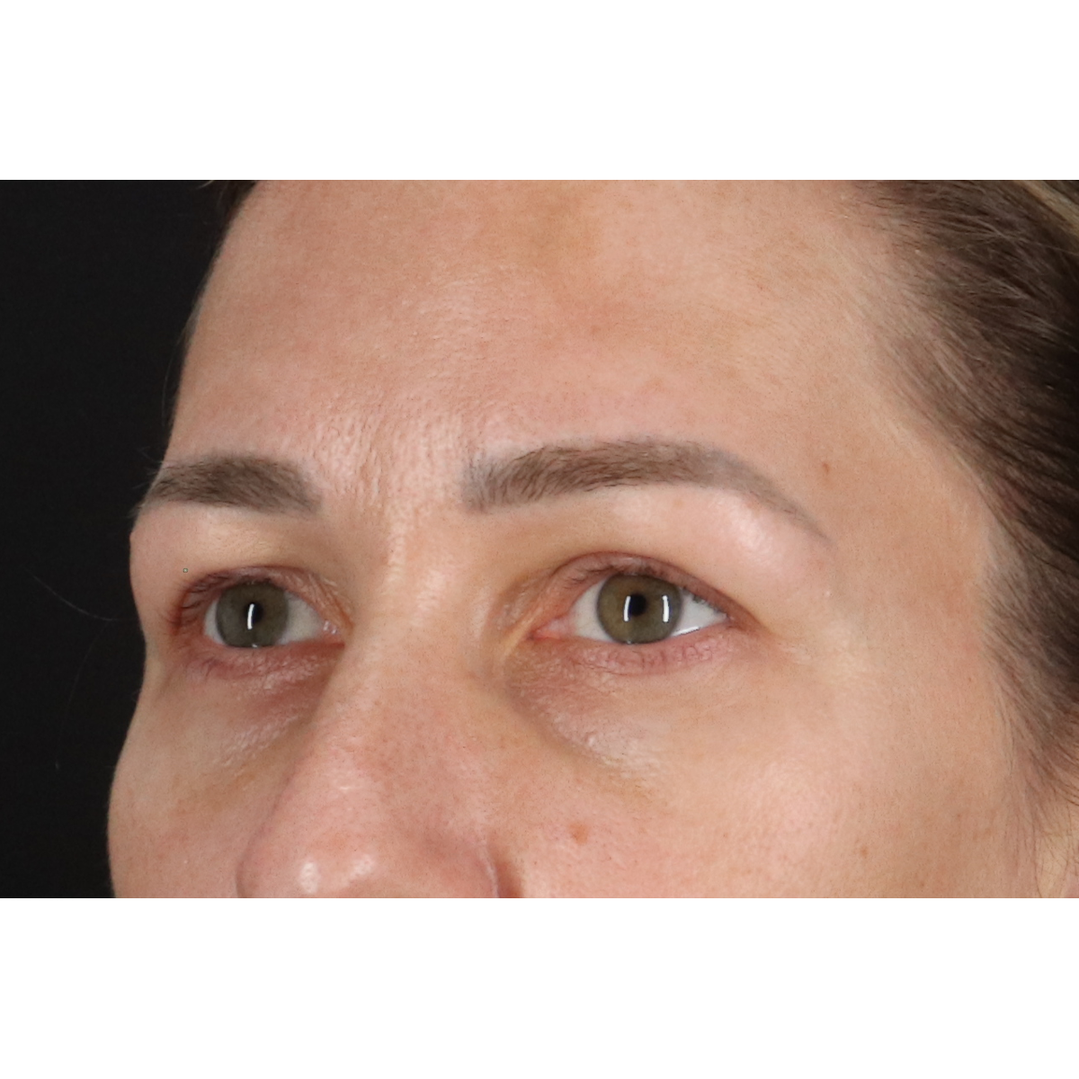 Blepharoplasty (Eyelid Surgery) Before & After Patient #11585