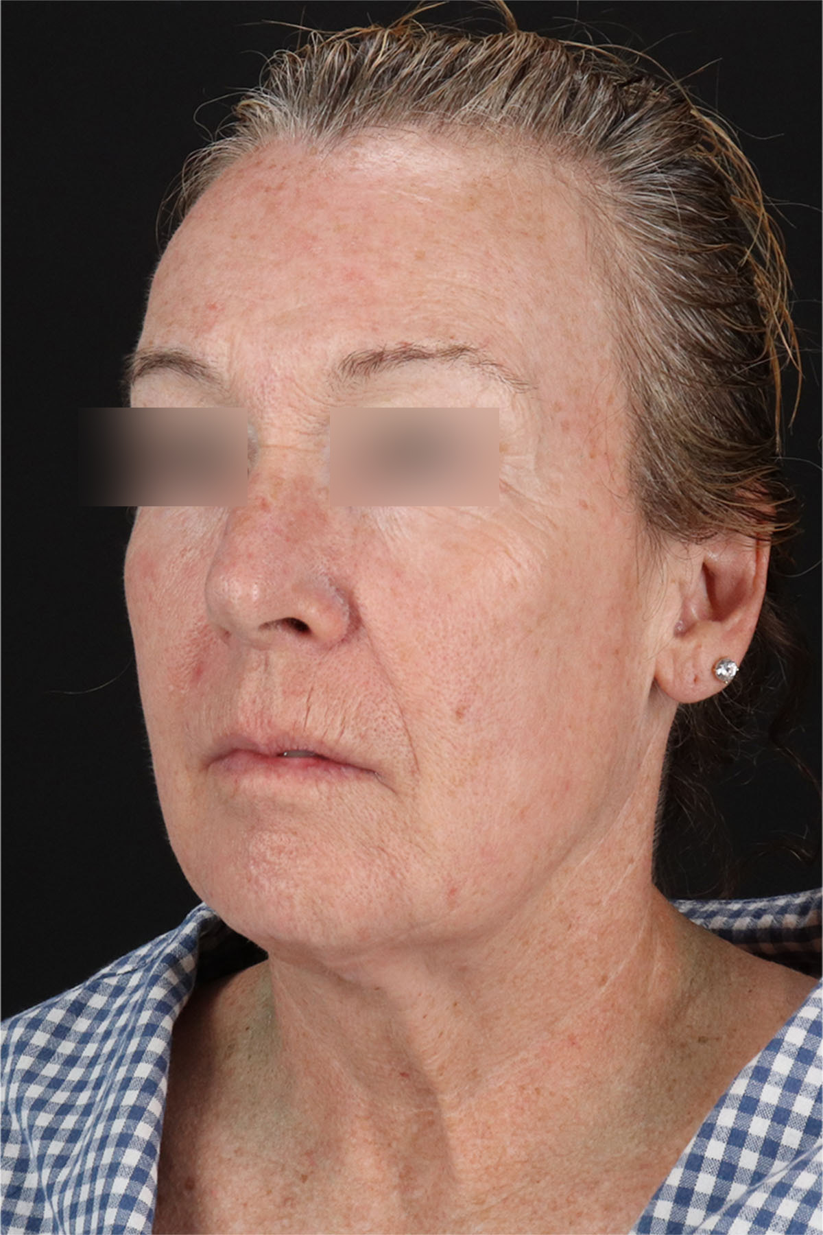 CO2 Laser Before & After Patient #11385
