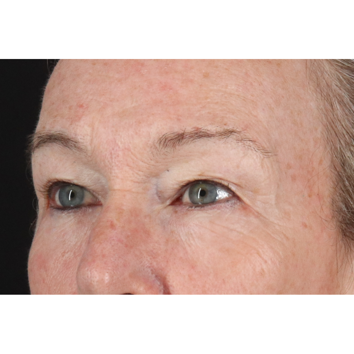 Blepharoplasty (Eyelid Surgery) Before & After Patient #11404
