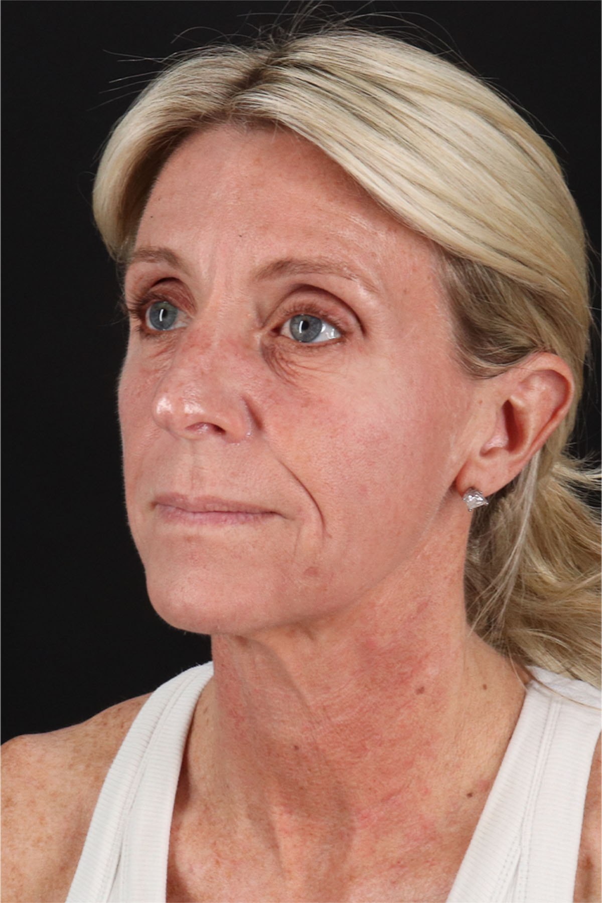 Facelift Before & After Patient #11682
