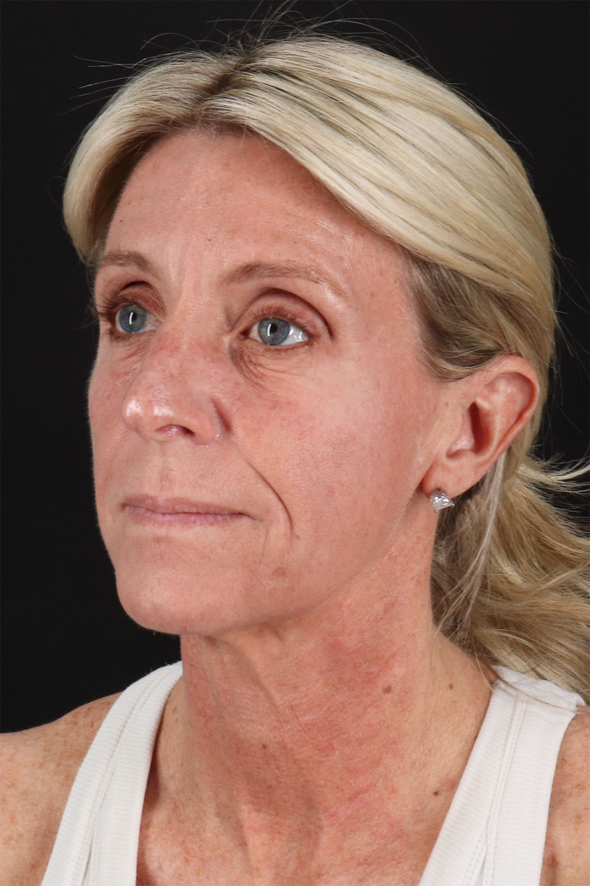 CO2 Laser Before & After Patient #11202