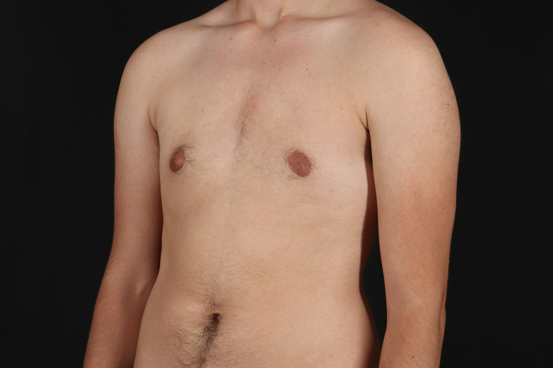 Female To Male Breast Before & After Patient #9981
