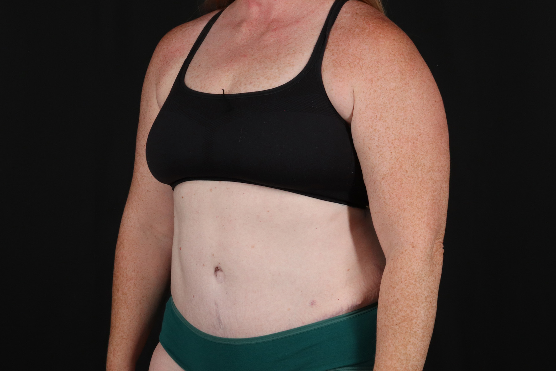 Abdominoplasty (Tummy Tuck) Before & After Patient #9980