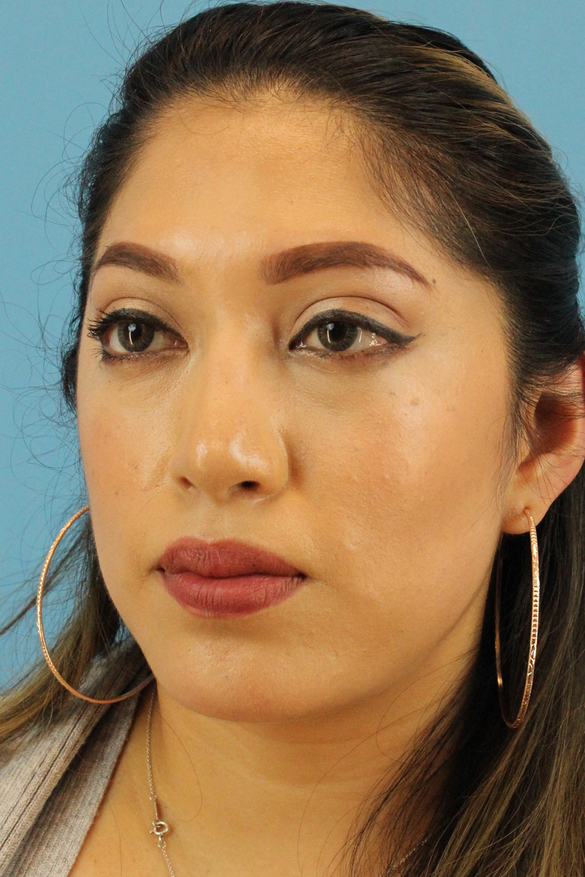 Chin Implant Before & After Patient #13673