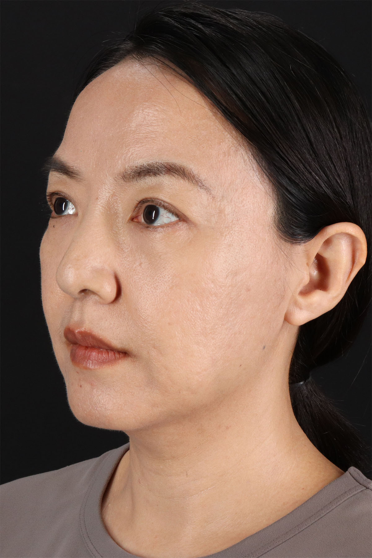 CO2 Laser Before & After Patient #11059