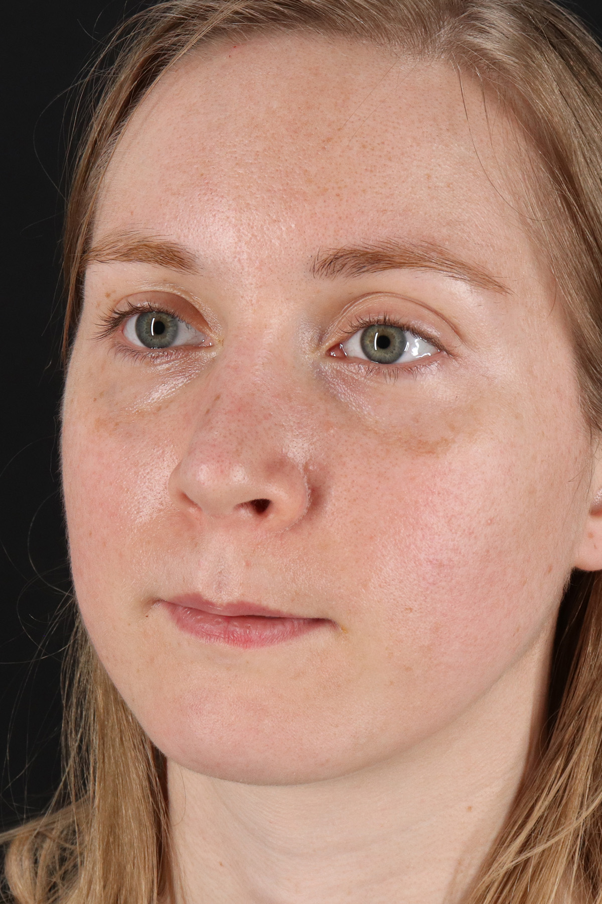 Rhinoplasty Before & After Patient #12238