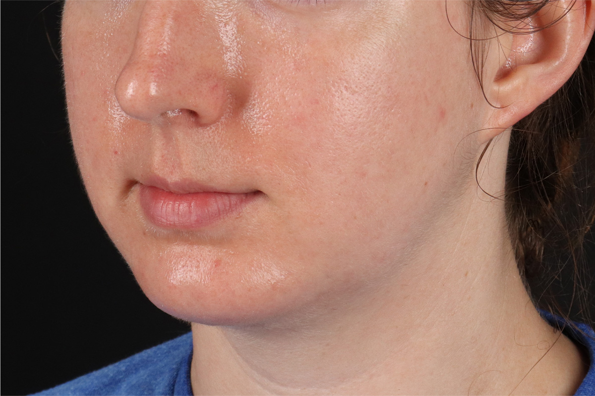 Chin Implant Before & After Patient #13761