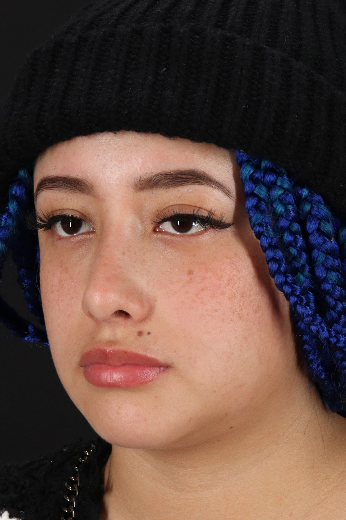 Rhinoplasty Before & After Patient #12491