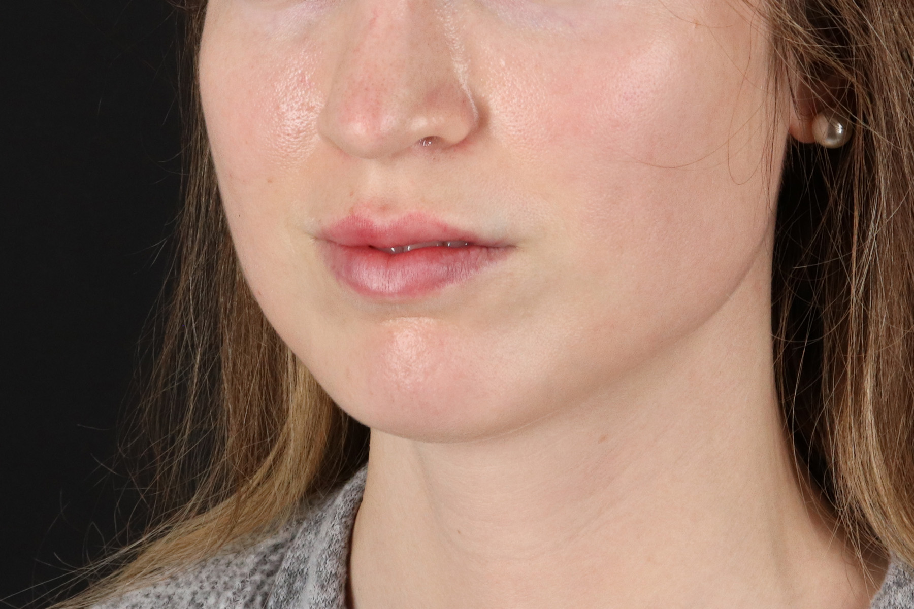 Buccal Fat Pad Before & After Patient #14025