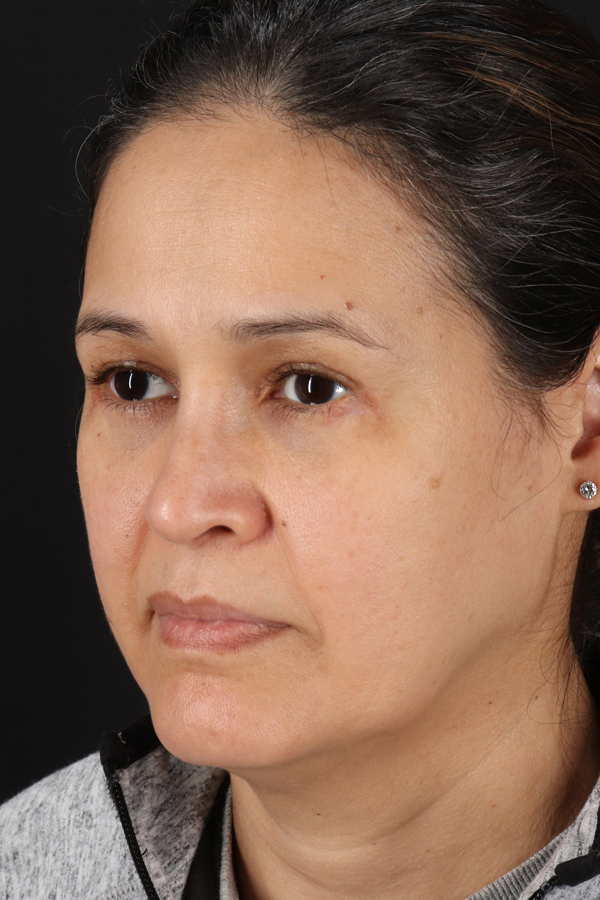 Rhinoplasty Before & After Patient #12205
