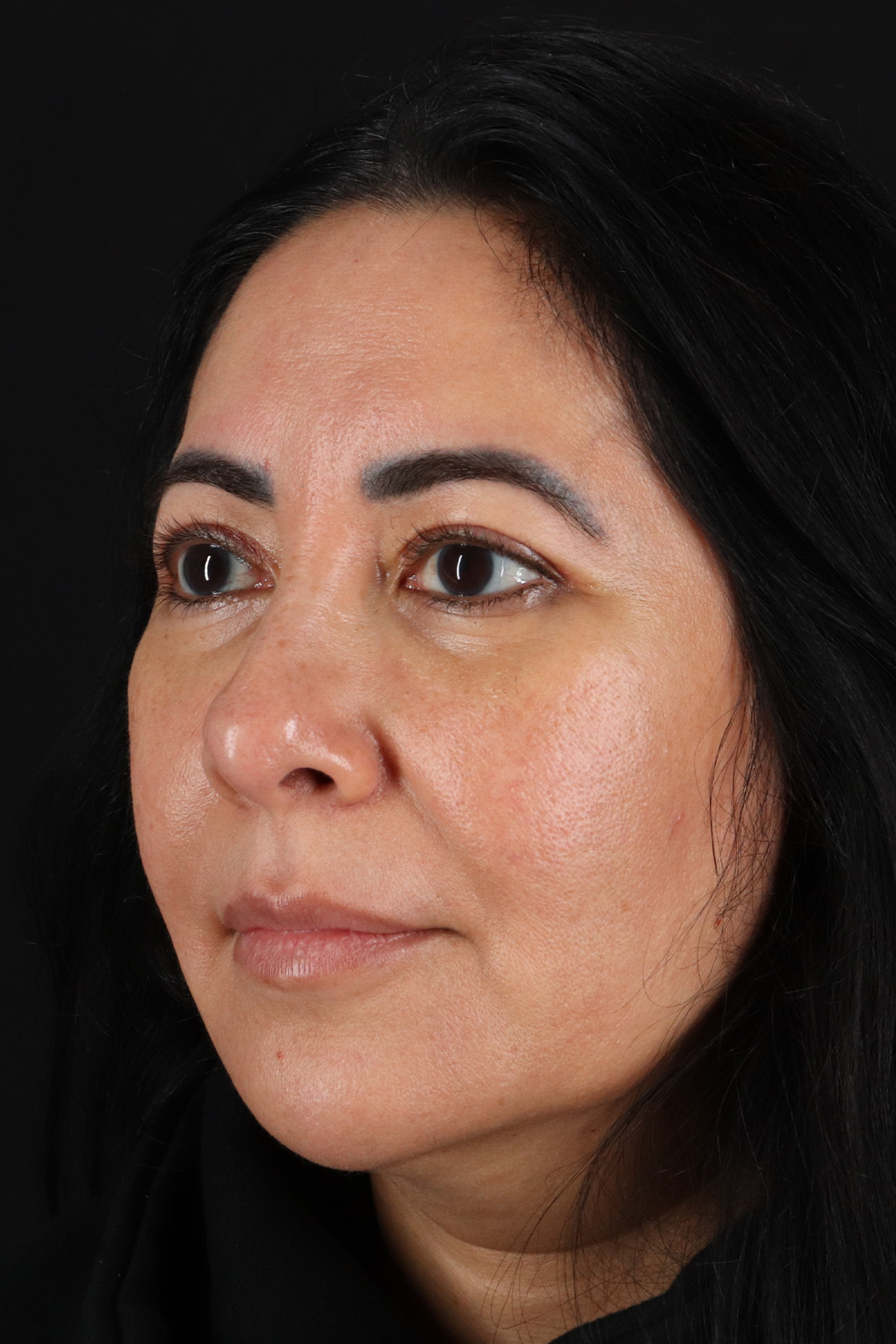 Upper Blepharoplasty Before & After Patient #12062