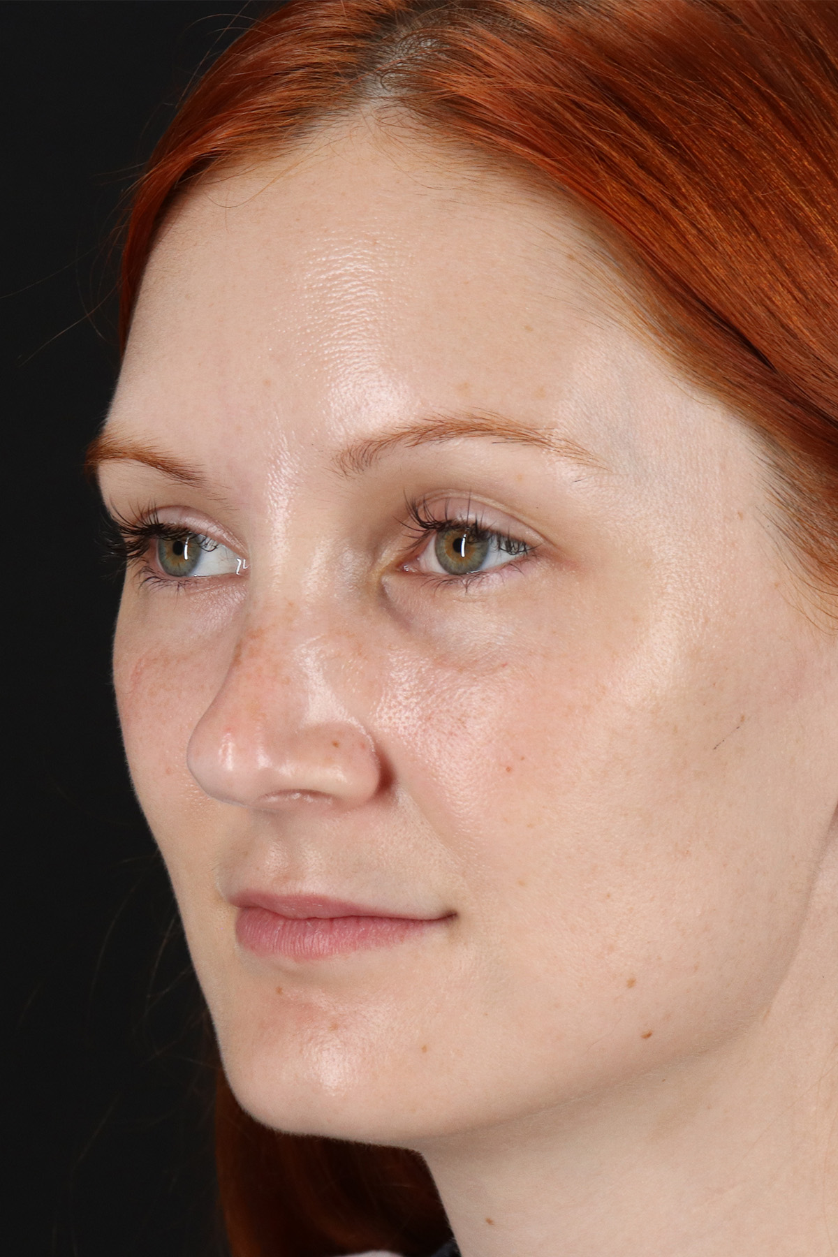 Lower Blepharoplasty Before & After Patient #13008