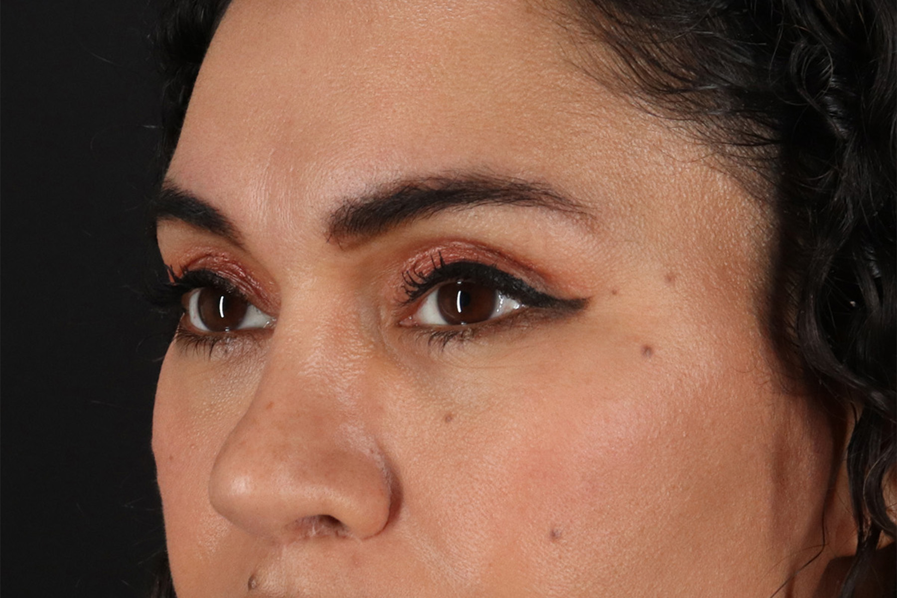 Upper Blepharoplasty Before & After Patient #12007