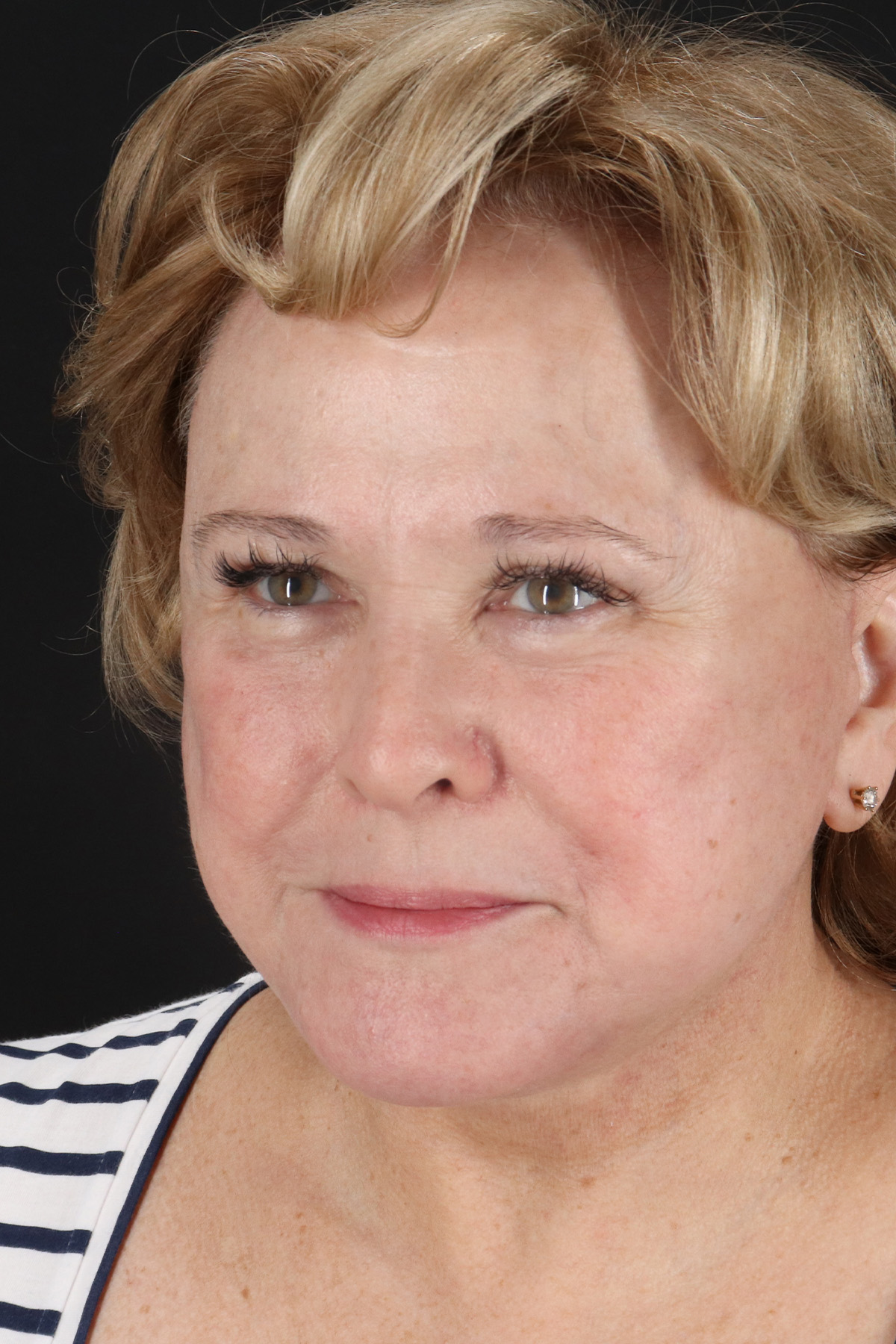 Facelift Before & After Patient #11695