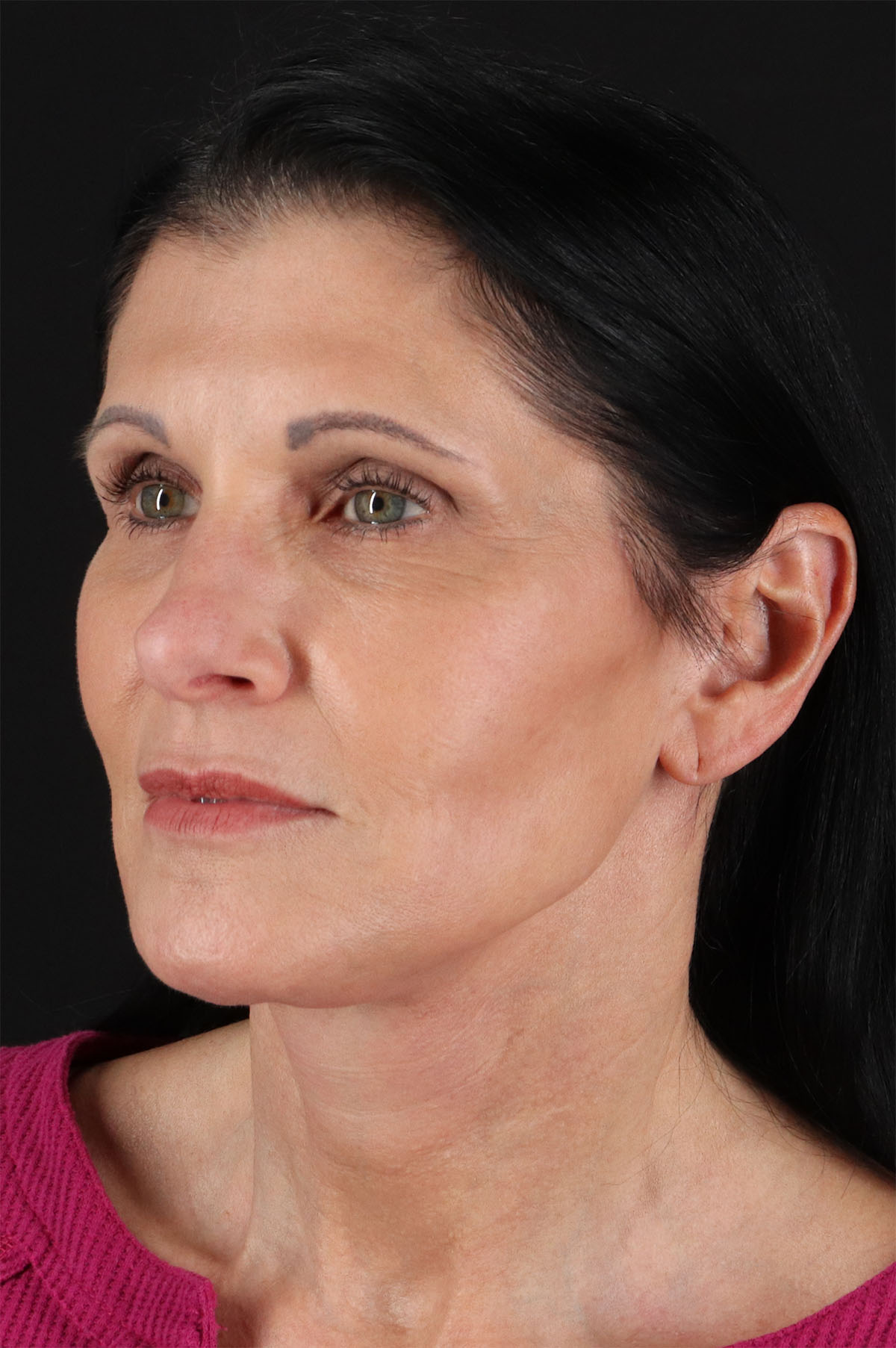Neck Lift Before & After Patient #12887