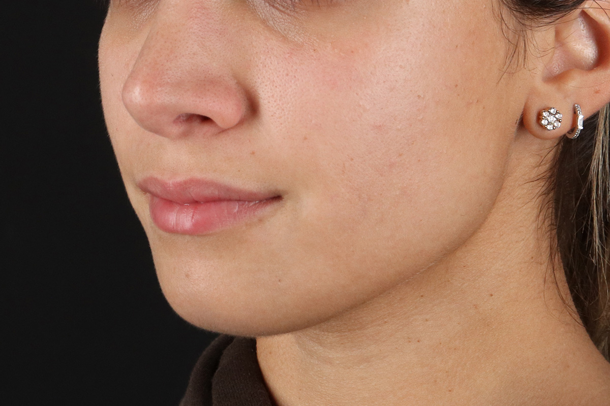 Chin Implant Before & After Patient #13750