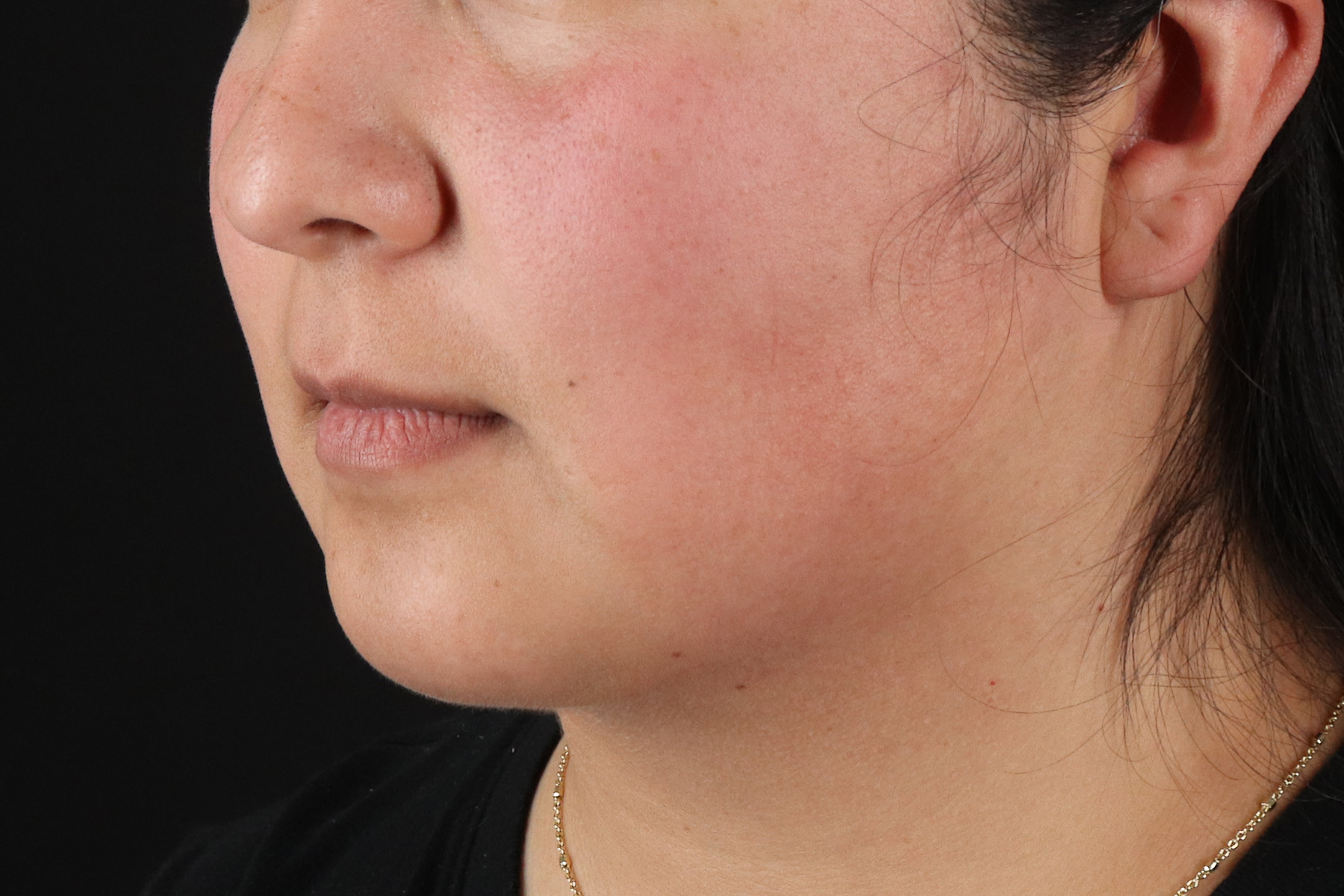 Chin Implant Before & After Patient #13794