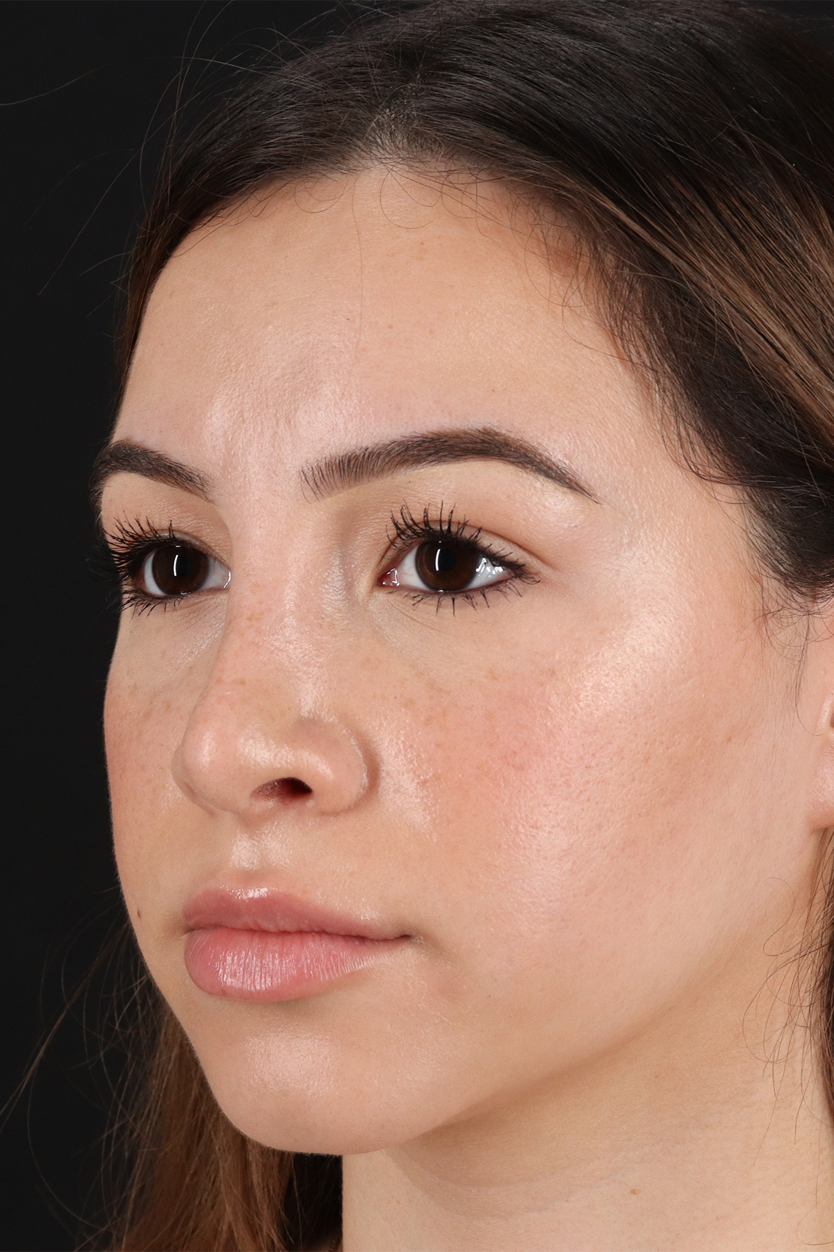 Rhinoplasty Before & After Patient #12271
