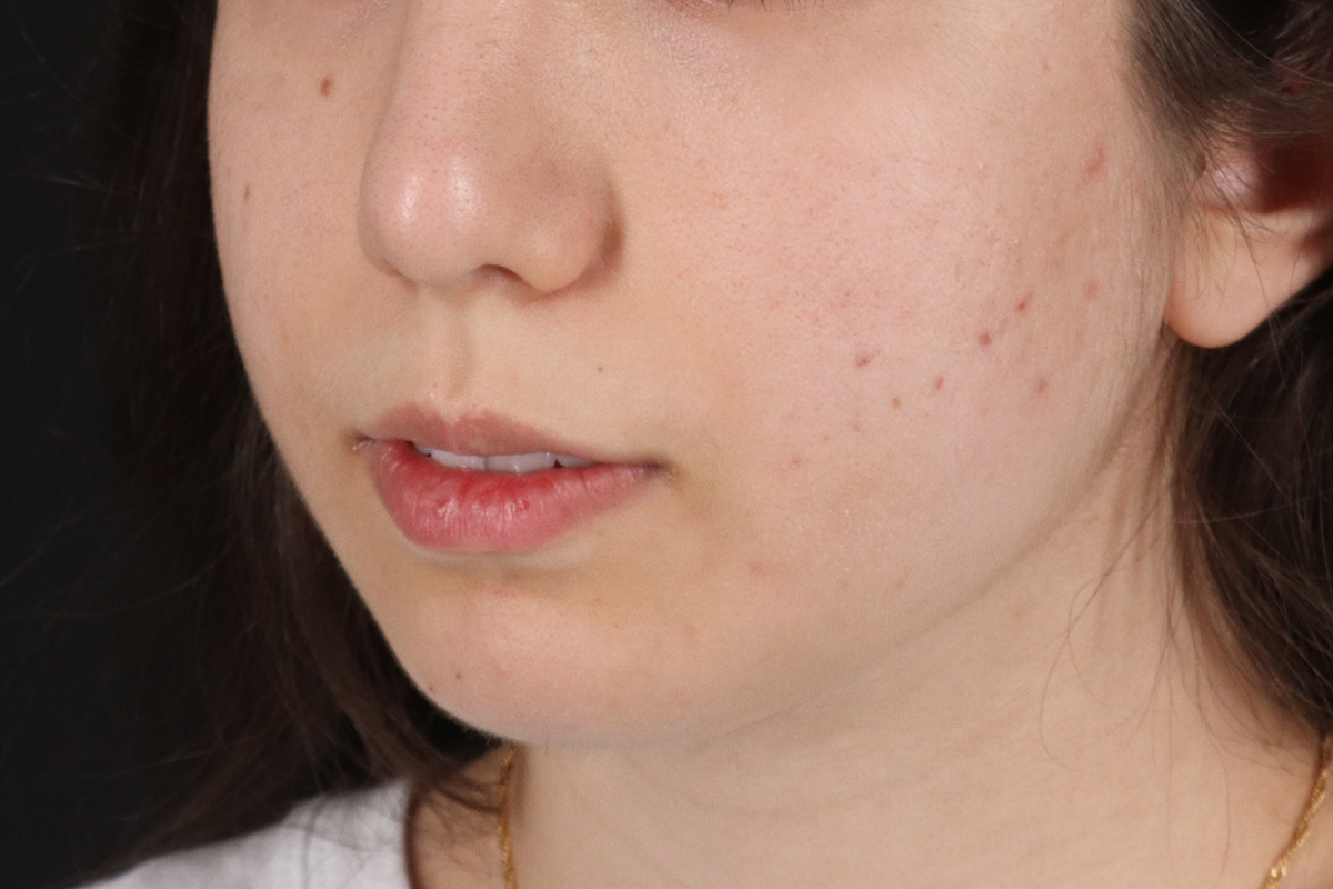 Chin Implant Before & After Patient #13772
