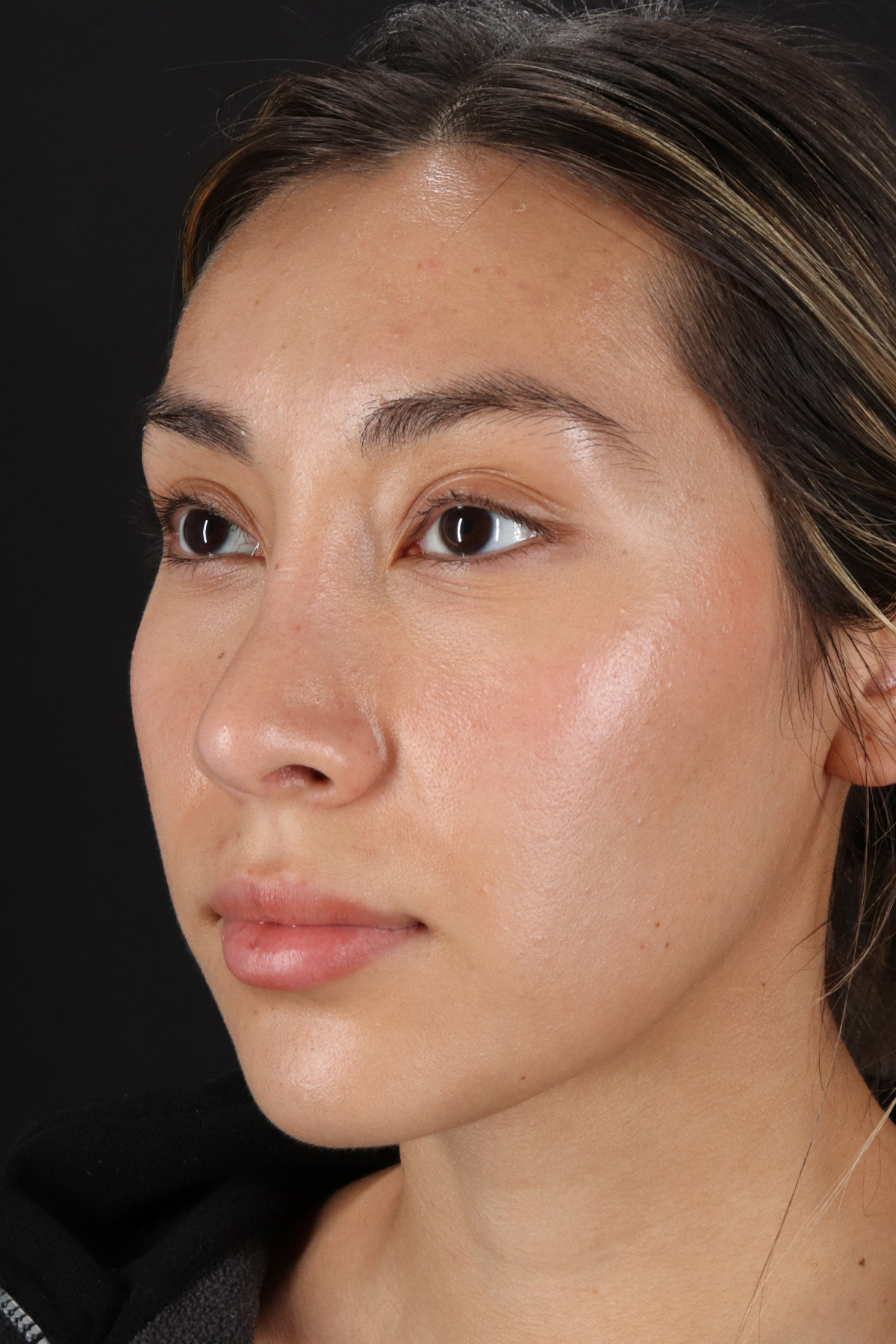 Rhinoplasty Before & After Patient #12480