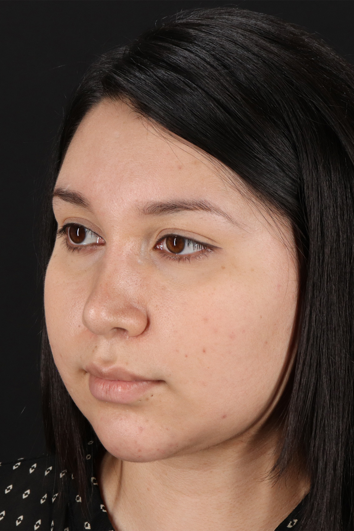 Chin Implant Before & After Patient #13739