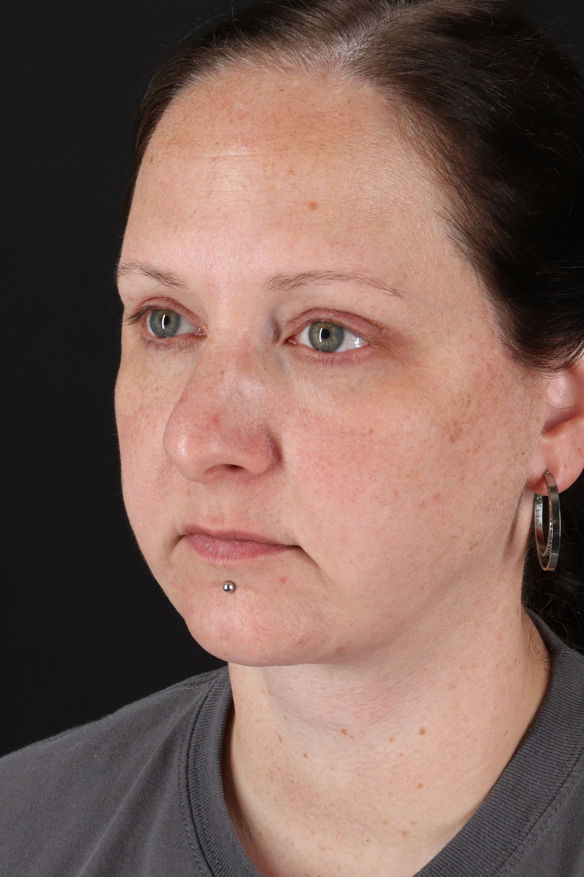 Lower Blepharoplasty Before & After Patient #13052